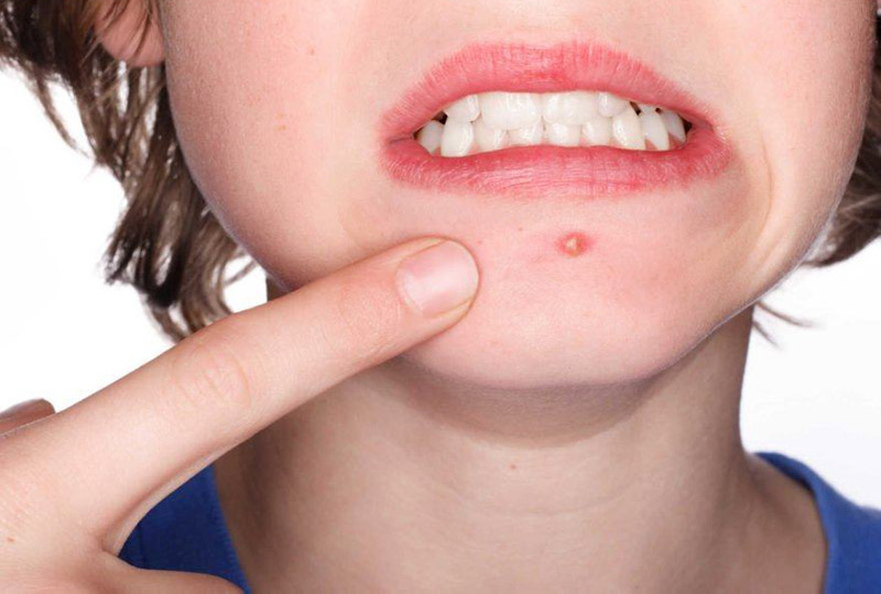 Giải mã giấc mơ thấy mọc mụn